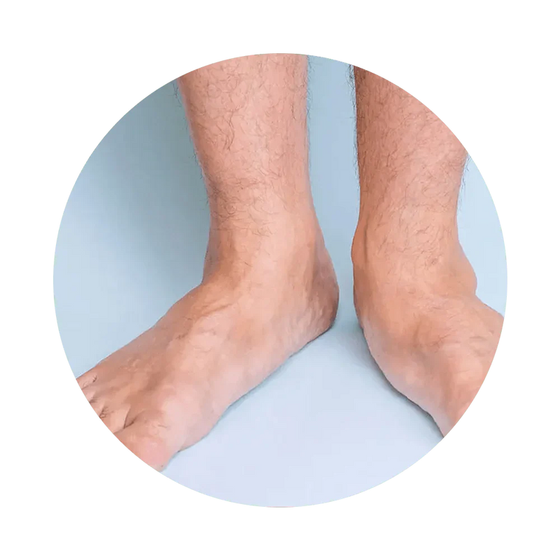 Flat Feet
